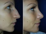 Nasenkorrektur Vorher - Nachher Bilder Nasen OP, Dr. Pichelm